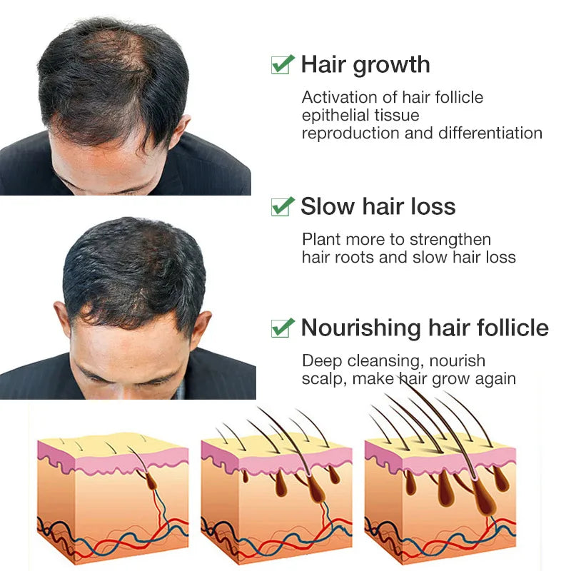 Hair Growth Serum Anti Loss Regrowth Hair Growth Oil Prevent Baldness Repair Damage Scalp Massage Moisturizing Nourish Hair Care